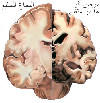 الزهايمر لقاح واعد ضد الالزهايمر