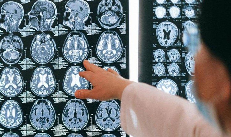 الزاهيمر “بالصدفة”… أطباء يكتشفون علاجاً محتملاً للألزهايمر