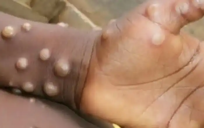 جدري القردة