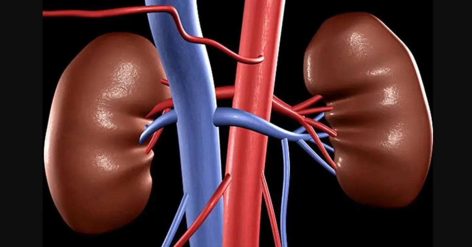 كلى للتخلص من حصوات الكلى… 5 علاجات طبيعية يمكنك اتباعها في المنزل
